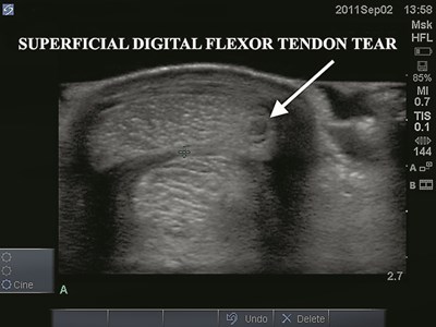 Managing Tendons: It Doesn’t Have To Be A Stretch