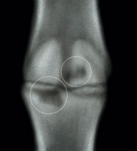 Bone Cyst: The Case of the Missing Bone